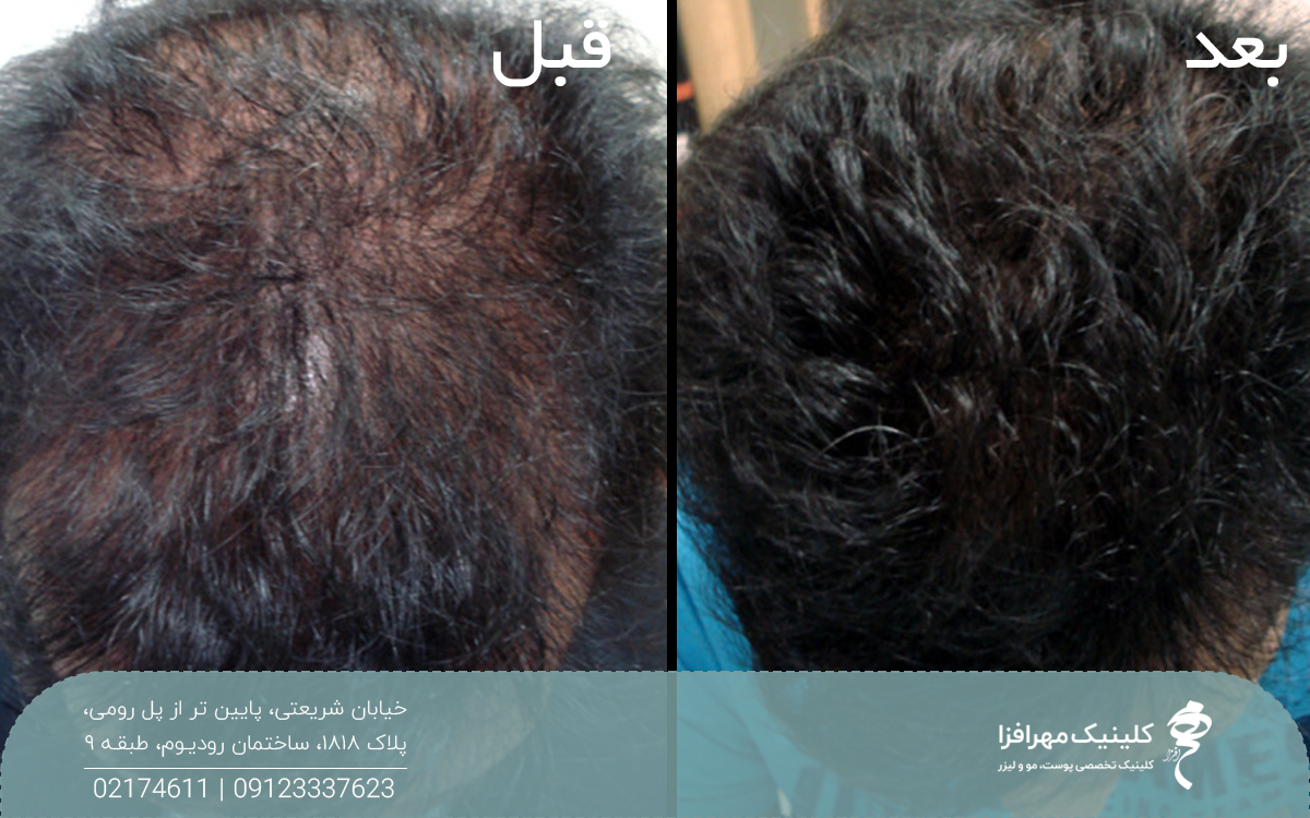 عکس قبل و بعد فردی که مزوتراپی مو انجام داده است و کم پشتی موهای او کاملا برطرف شده است