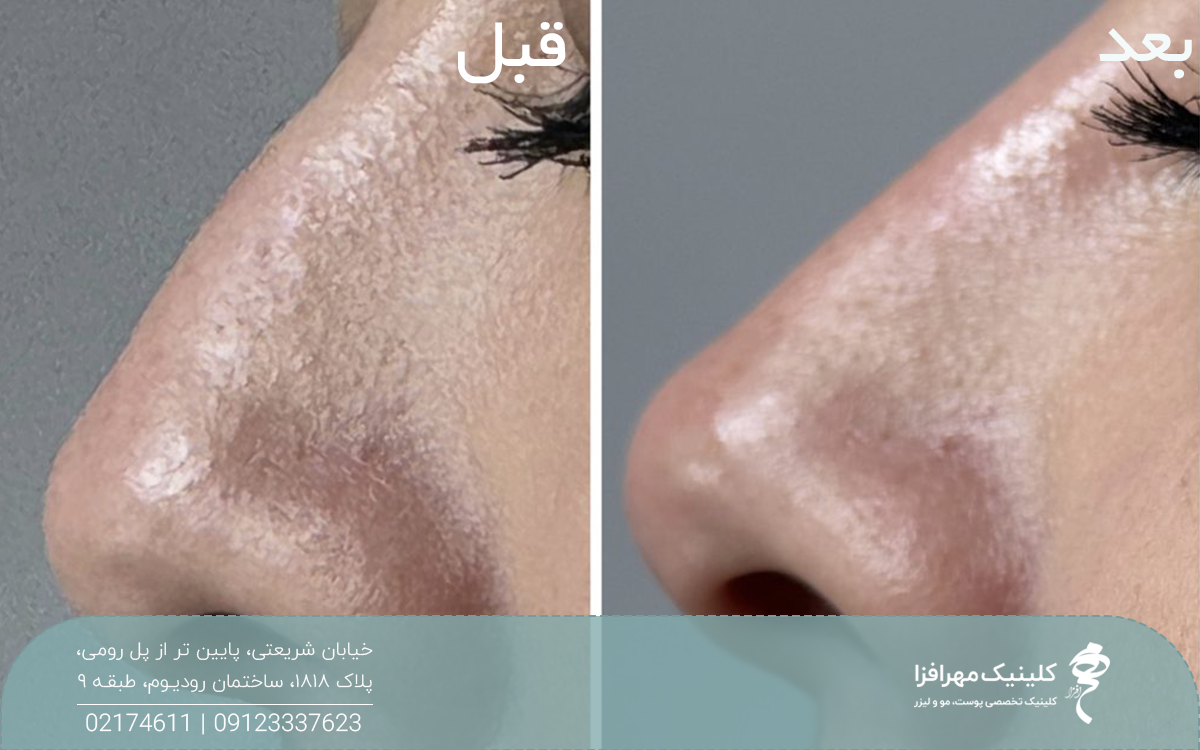 عکس قبل و بعد دختری که اندولیفت بینی انجام داده است و قوز و افتادگی بینی او رفع شده است