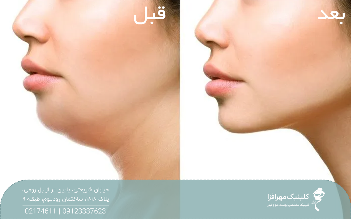عکس قبل و بعد دختری که هایفوتراپی غبغب انجام داده است
