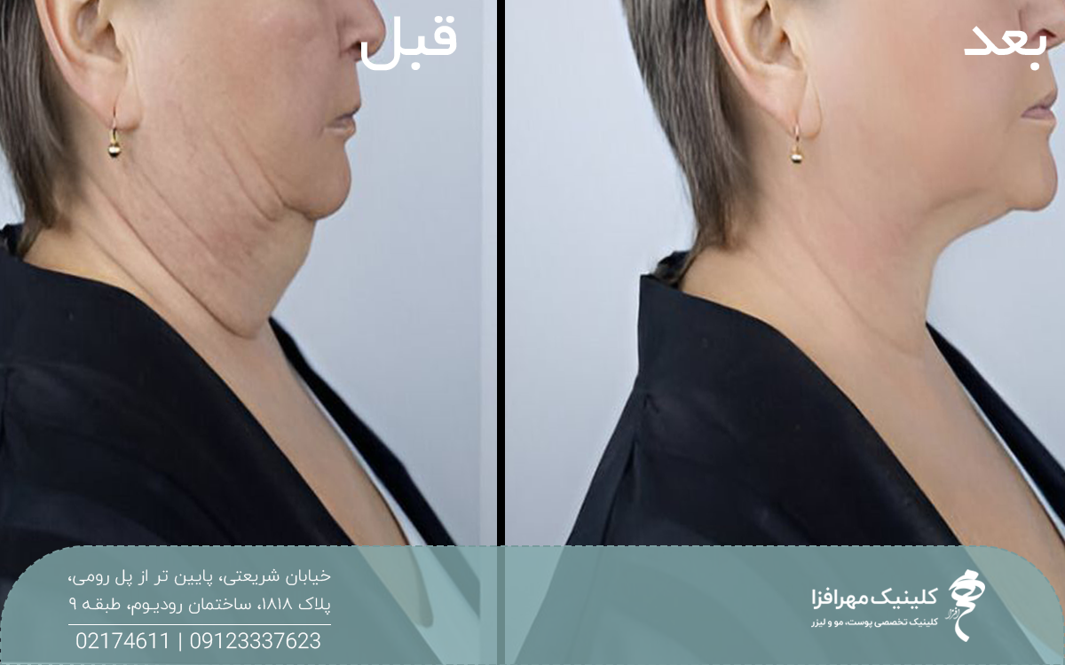 عکس قبل و بعد زن مسنی که اندولیفت غبغب انجام داده است