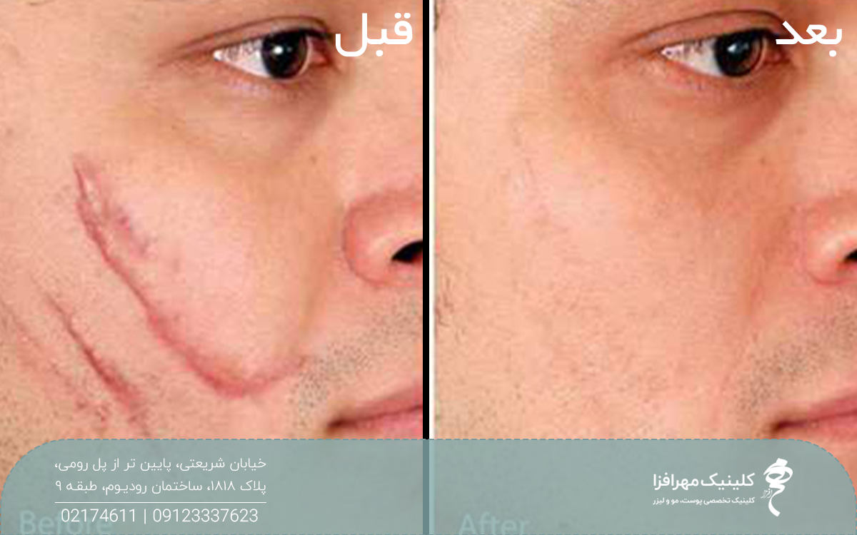 عکس قبل و بعد فردی که سابسیژن انجام داده است