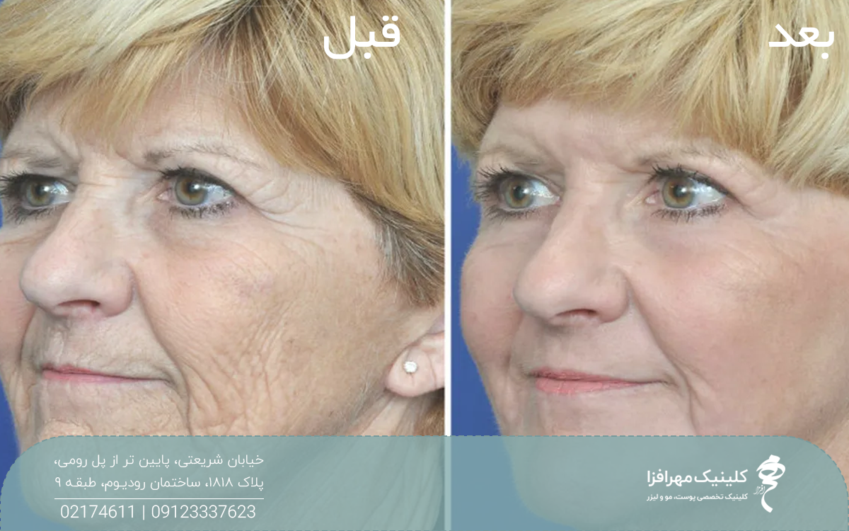 عکس قبل و بعد زن میانسالی که تزریق مزوژل انجام داده است