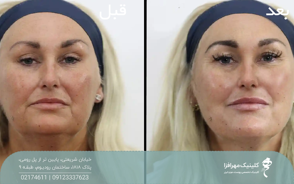 عکس قبل و بعد زنی که لیفت صورت با نخ انجام داده است