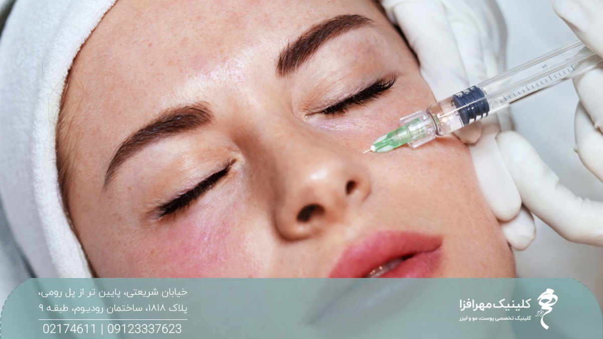 دختری که چشم های خود را بسته و پزشک زیر چشم های او را مزوتراپی می کند که باعث قرمز زیر چشم راست او شده است
