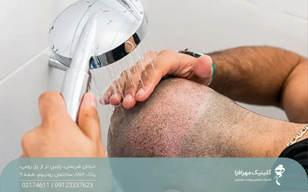 مردی که بعد از کاشت مو در حال شستن پشت سرش زیر دوش است