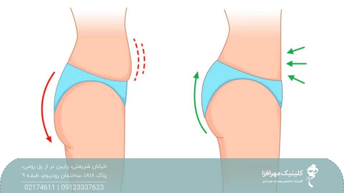 عکسی که فرم باسن و شکم قبل و بعد از تزریق چربی را نشان داده است