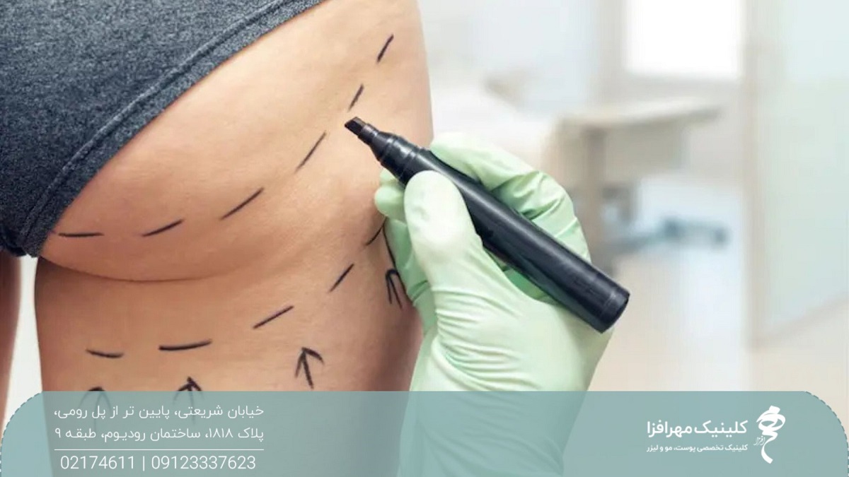 باسن فرد در حالی که پزشک با ماژیک روی آن خطوطی را کشیده است