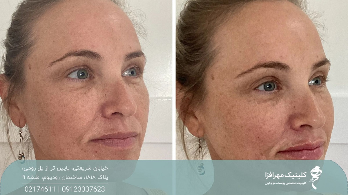 عکس قبل و بعد تزریق ژل گونه در حجم پایین و ظاهر طبیعی به صورت زن