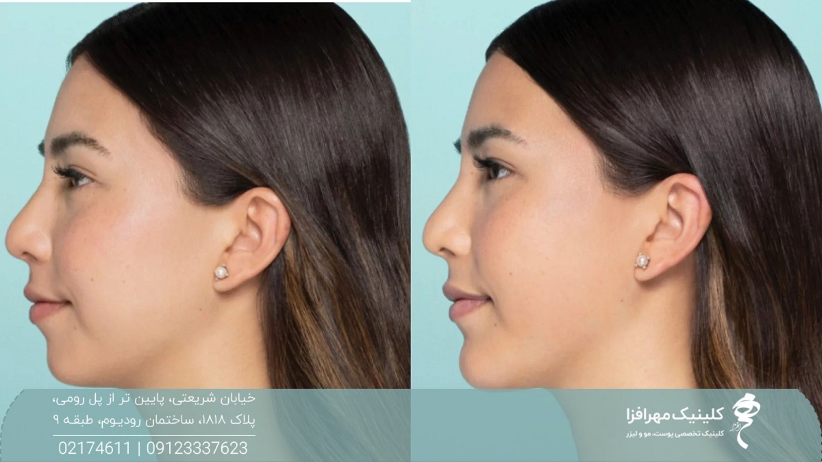 عکس قبل و بعد تزریق ژل چانه دختر