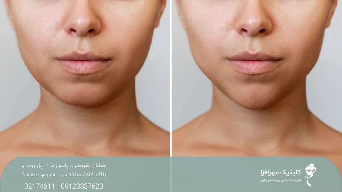 عکس قبل و بعد تزریق ژل چانه که باعث زاویه سازی صورت دختر شده است