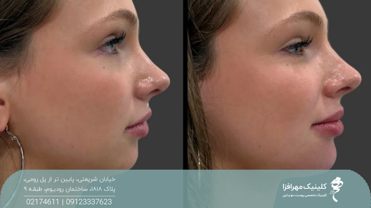 عکس نیم رخ از قبل و بعد دختری که تزریق فیلر چانه انجام داده است و تناسب صورت او بیشتر شده است