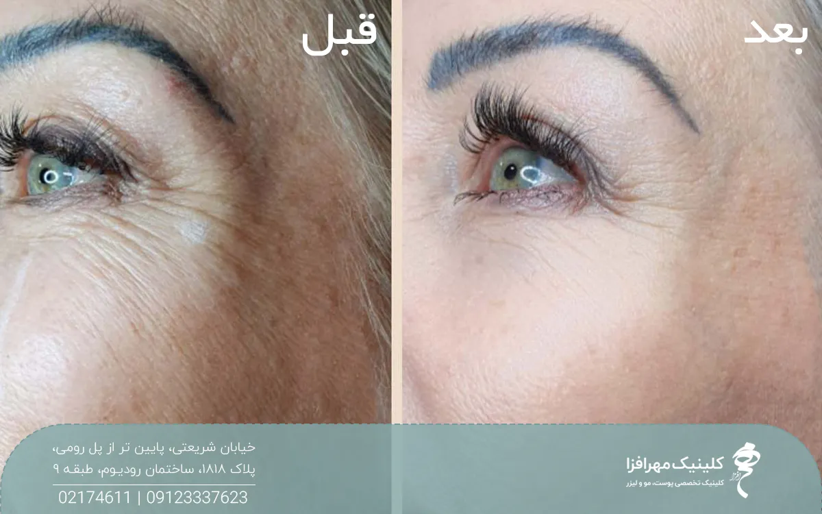 عکس قبل و بعد زنی که تزریق پروفایلو انجام داده است