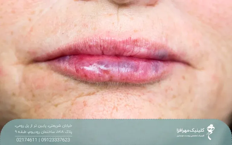 عکس از لب فردی که کبود شده است