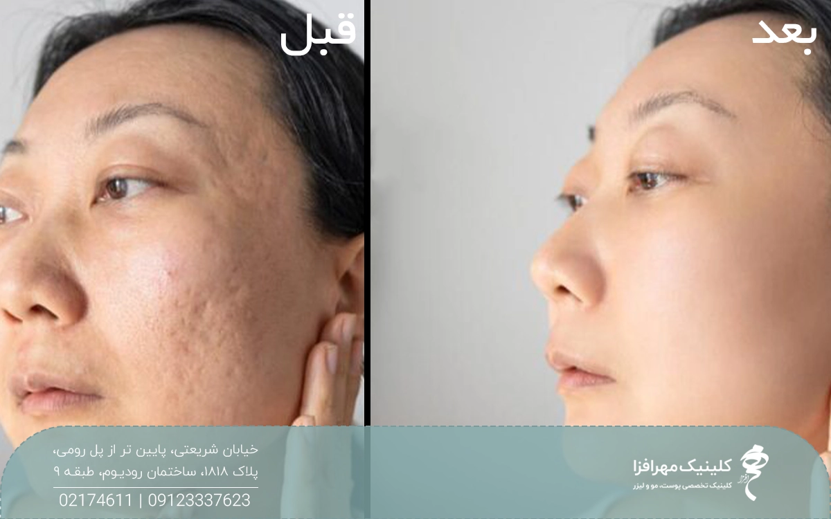 عکس قبل و بعد دختری که لیزر CO2 فرکشنال انجام داده است