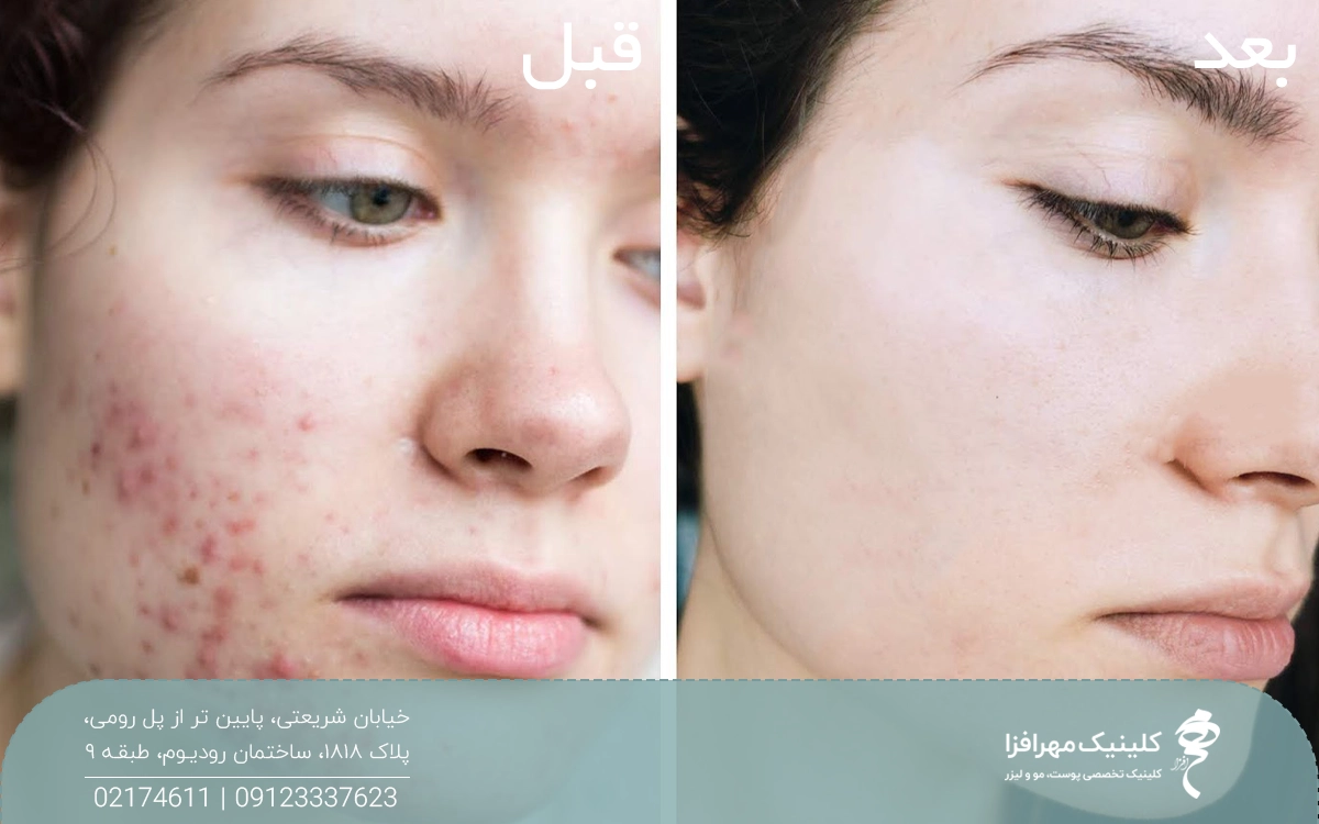 عکس قبل و بعد دختری که جوش هایش درمان شده است