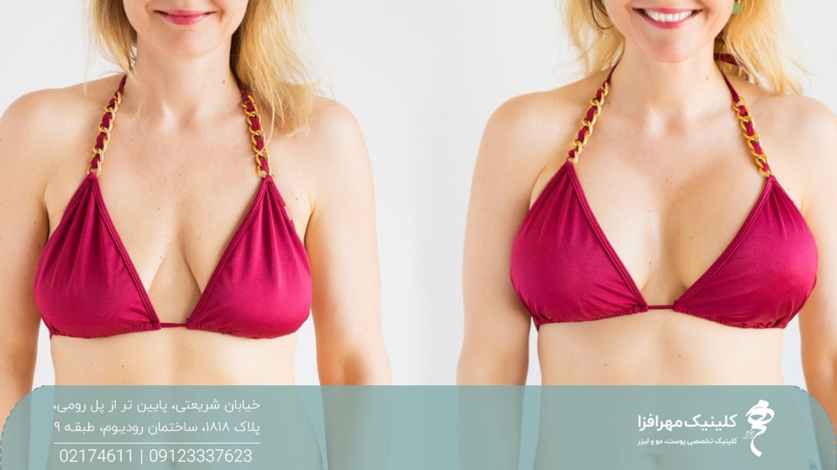 عکس قبل و بعد تزریق چربی به سینه زن