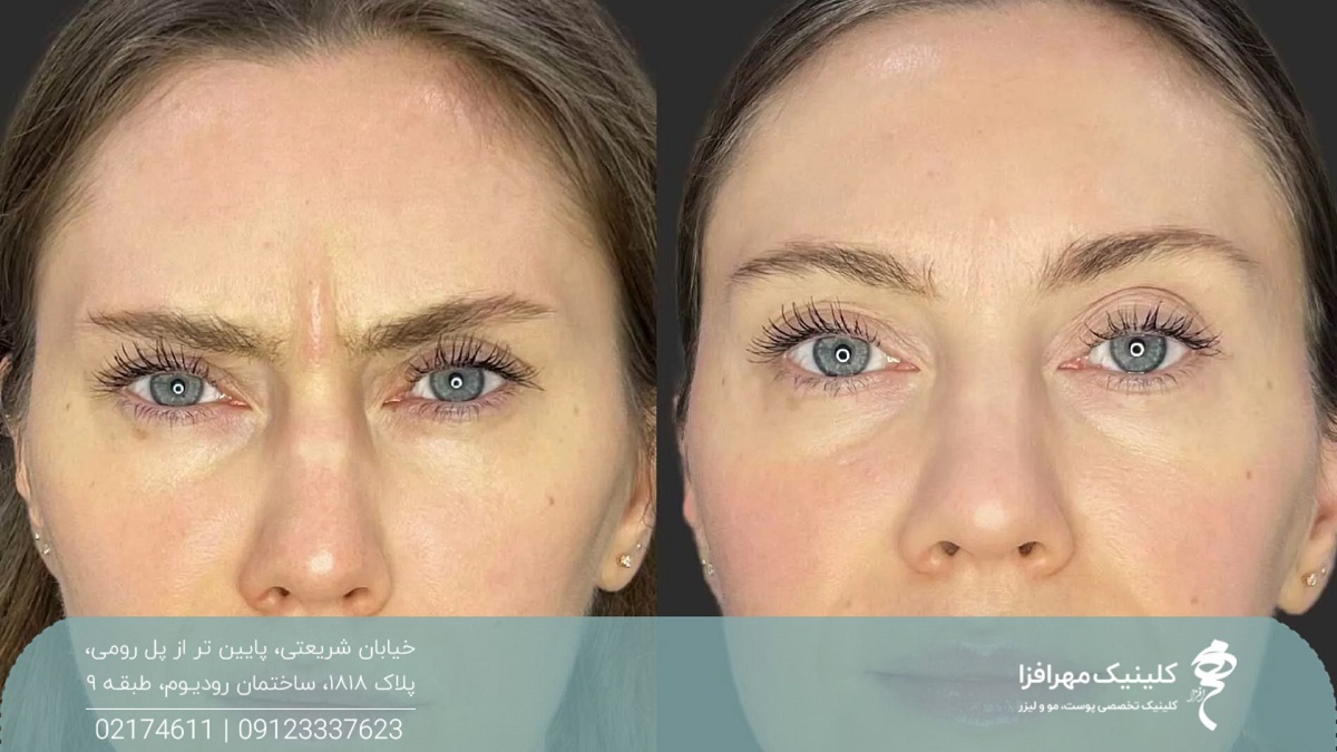 عکس قبل و بعد تزریق بوتاکس پیشانی برای زن