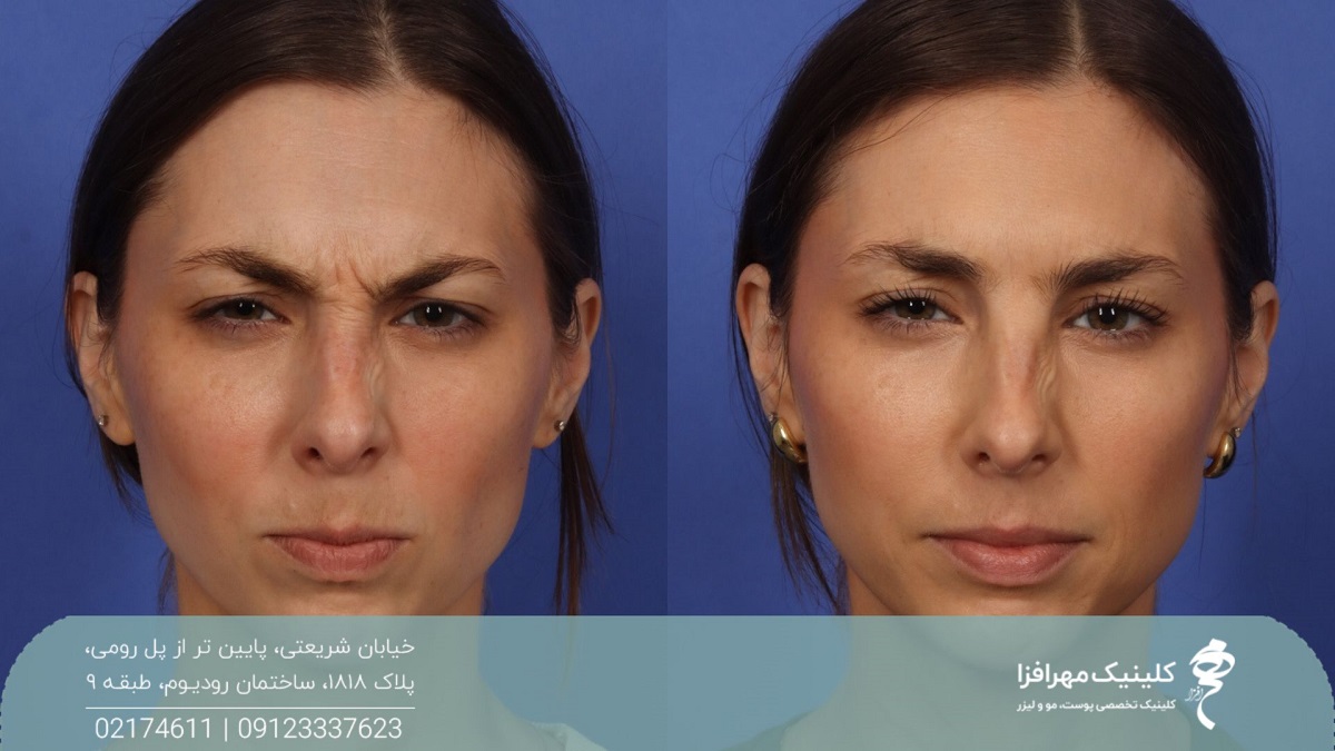 عکس قبل و بعد تزریق بوتاکس پیشانی به صورت دختر که باعث از بین رفتن خطوط و چین و چروک های بین دو ابروی دختر شده است