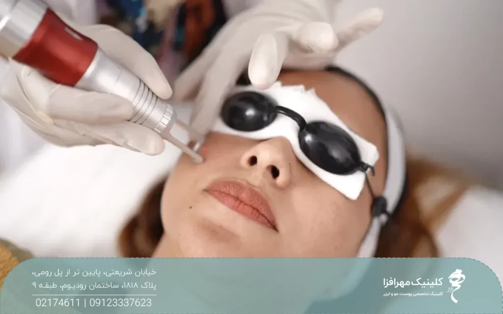 دختری که روی تخت دراز کشیده و عینک محافظ روی چشمش است و اپراتور لیزر co2 فرکشنال صورت او را لیزر می کند