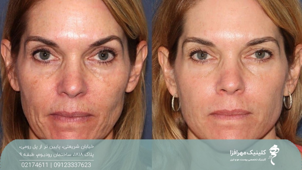 عکس قبل و بعد تزریق فیلر فول فیس چین و چروک را در نواحی مختلف صورت مثل خط خنده، خط غم و چروک های بالای لب رفع کرده و باعث لیفت جزئی صورت شده است
