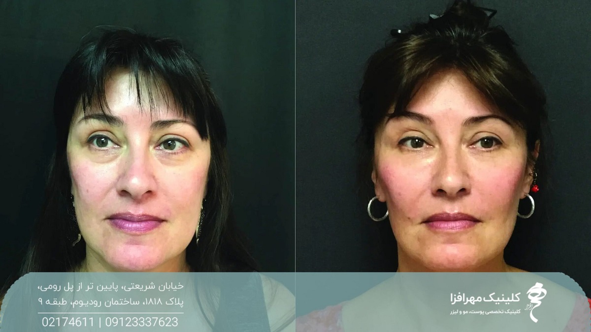 عکس قبل و بعد تزریق فیلر فول فیس به صورت زن میانسال که صورت را کانتور کرده است