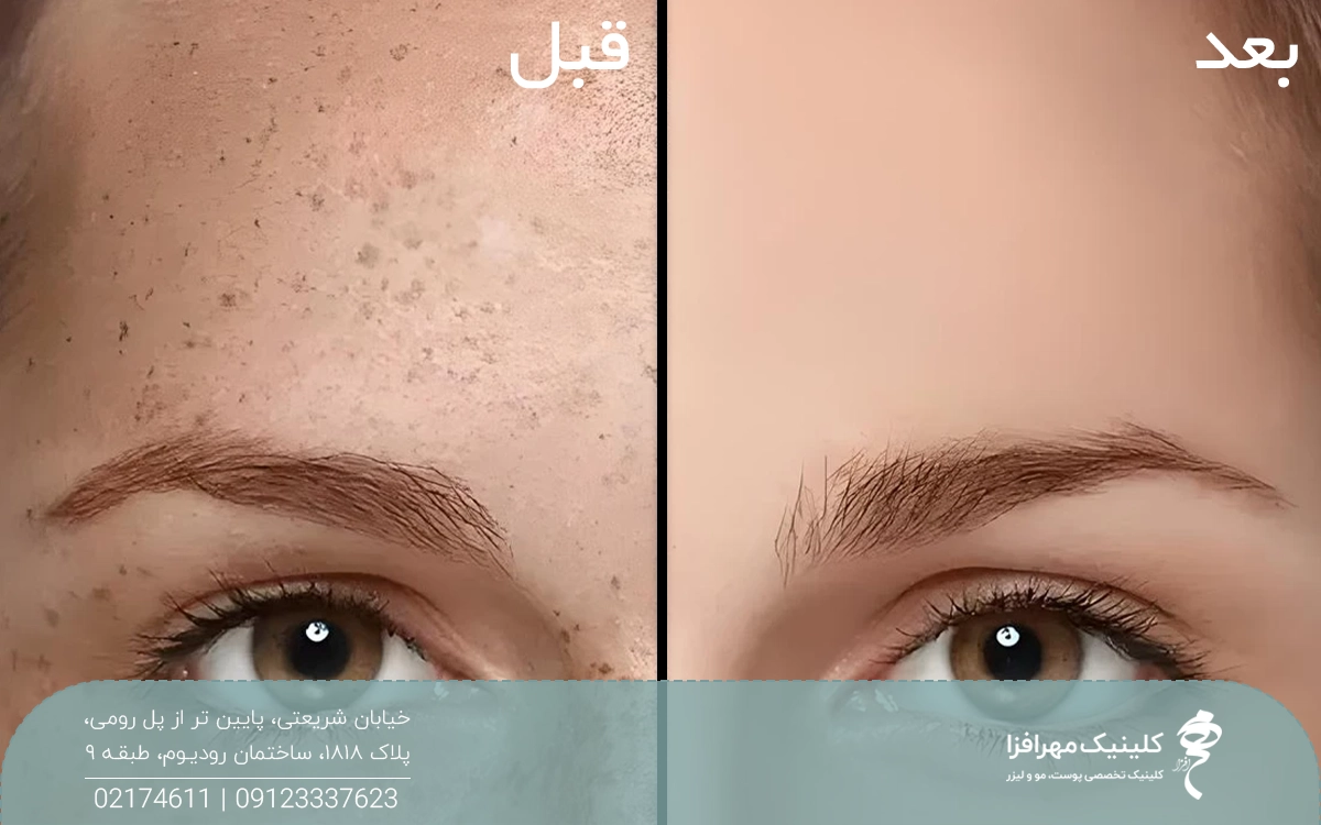 عکس قبل و بعد درمان لک صورت دختر با لیزر کیوسوییچ
