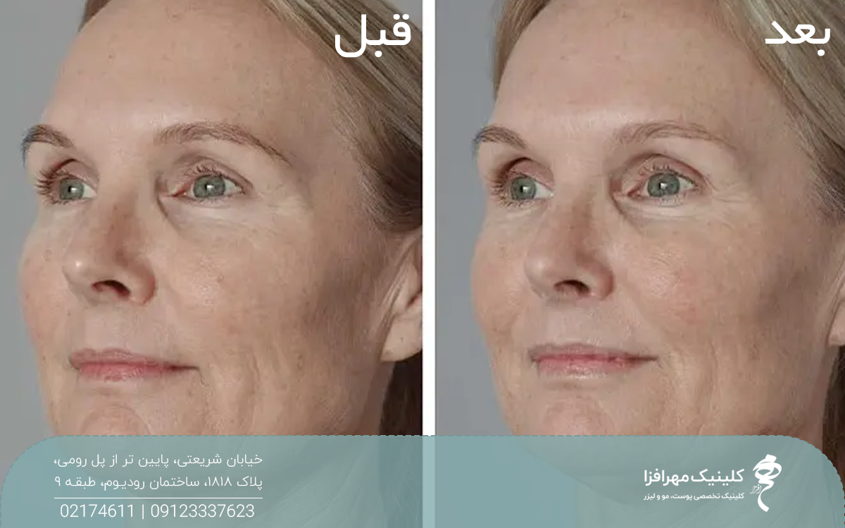 عکس قبل و بعد زنی که تزریق پروفایلو استراکچرا انجام داده است