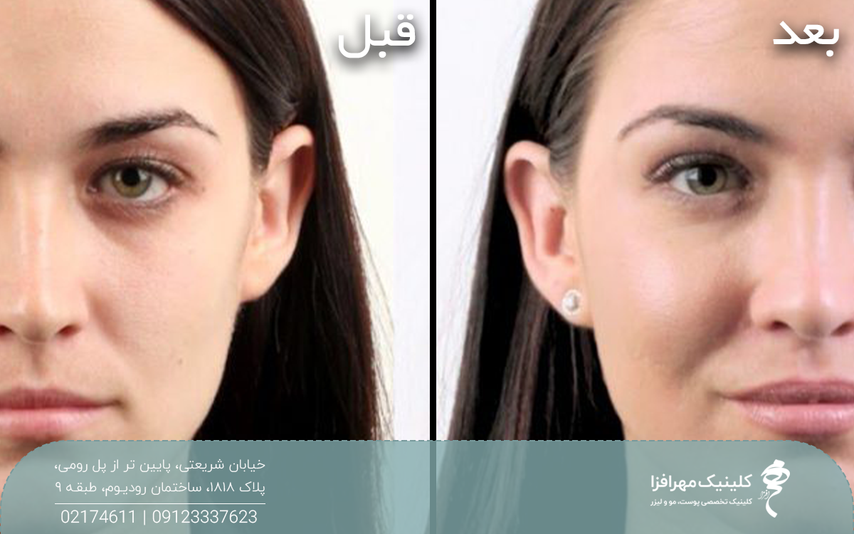 عکس قبل و بعد دختری که به گونه و خط لبخند خود ژل تزریق کرده است