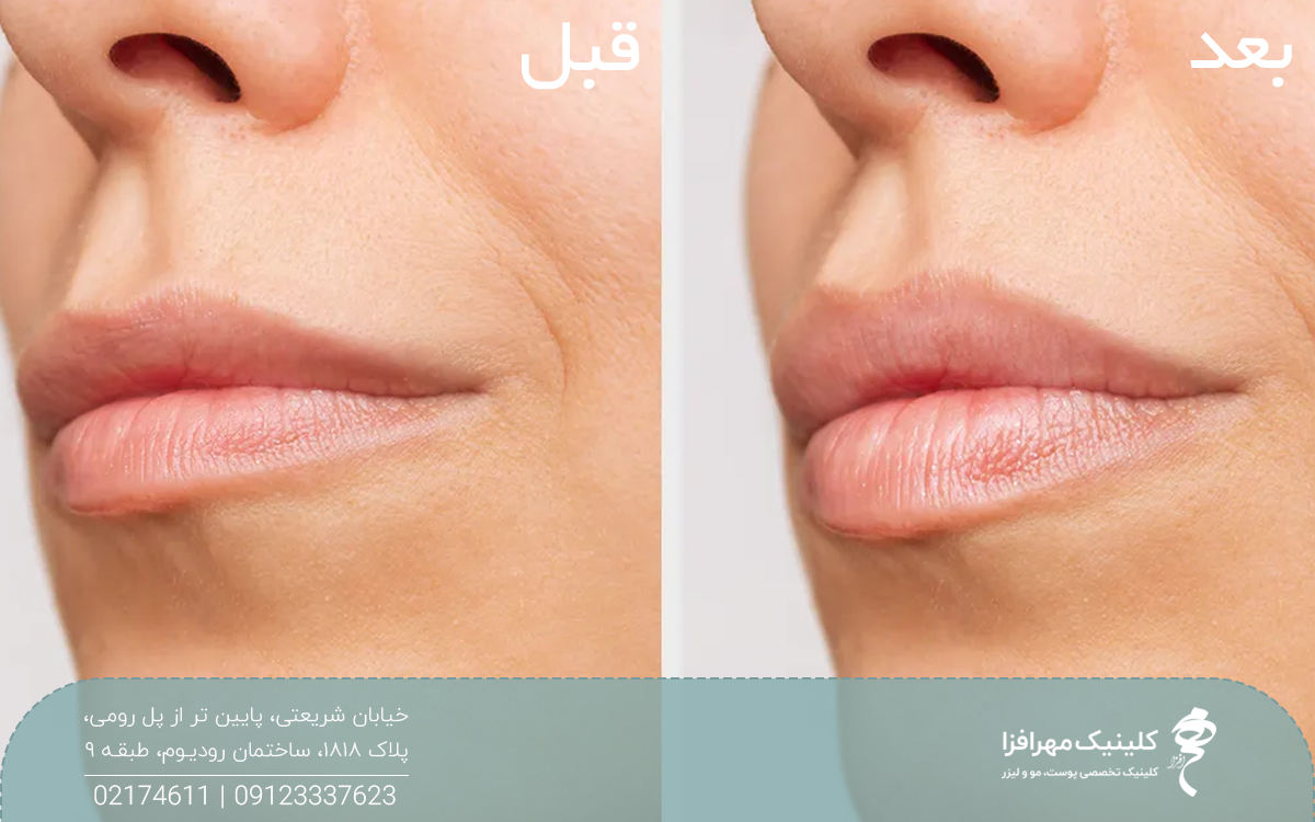 عکس قبل و بعد تزریق ژل لب نچرال به زن