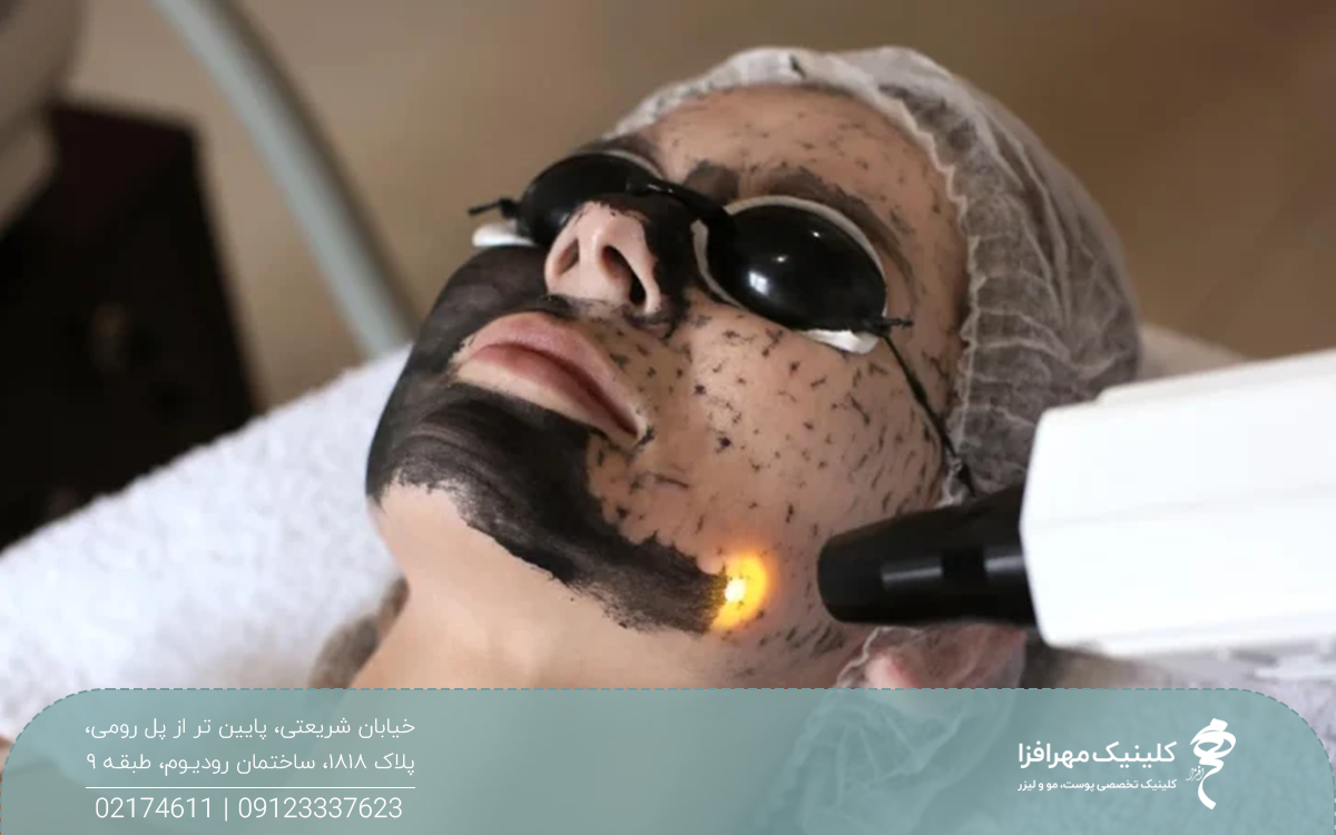 دختری که روی تخت کلینیک دراز کشیده و روی صورت او ماسک زغال است و اپراتور با پیلینگ کربن صورت او را پاکسازی می کند
