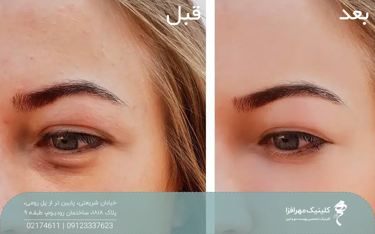 عکس قبل و بعد دختری که پی آر پی صورت انجام داده است