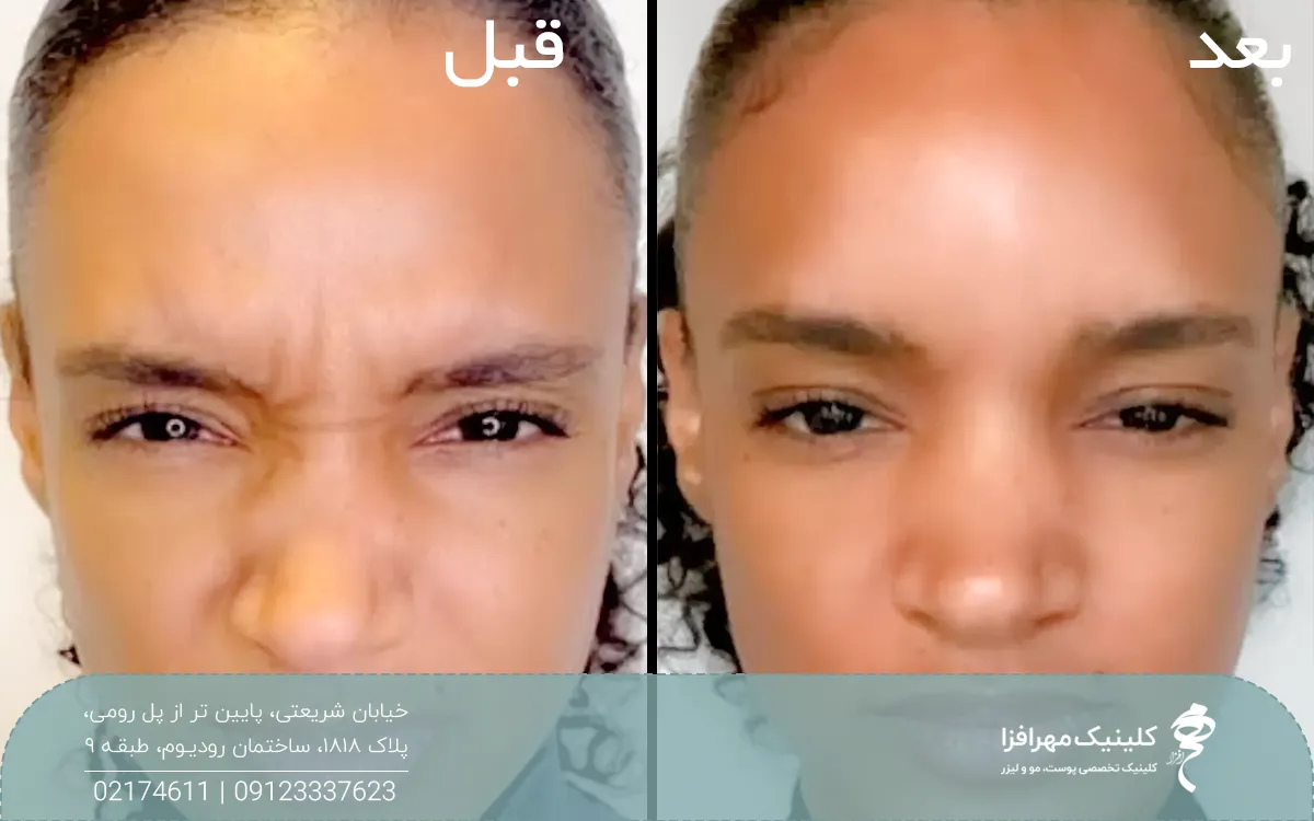 عکس قبل و بعد دختری که تزریق بوتاکس خط اخم انجام داده است