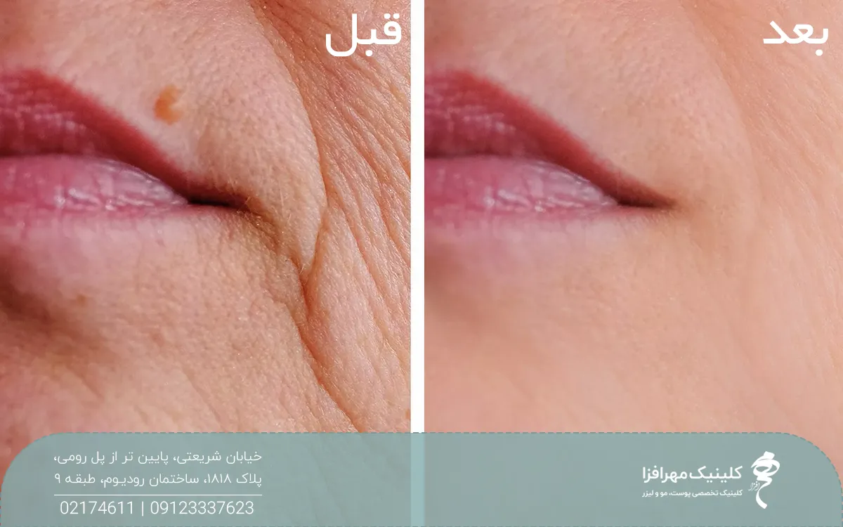 دختری که لبخند زده و اطراف دهان او خطوط و چین و چروک مشخص شده است