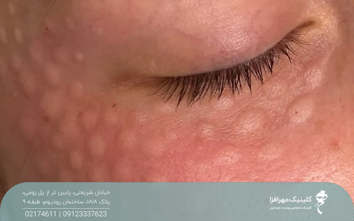 فردی که مزوژل زیر چشم انجام داده است و زیر و اطراف چشمش دچار تورم های متعدد در محل های تزریق شده است