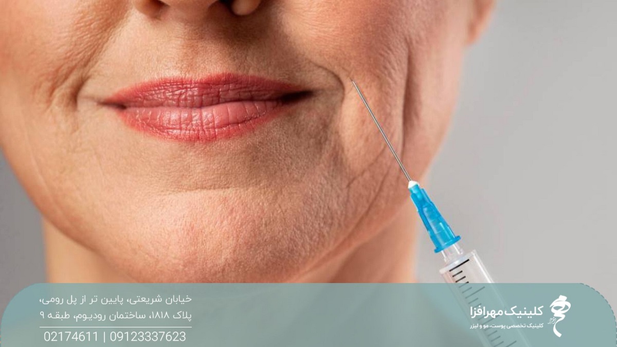 عکس از نیمه پایین صورت زن مسن که چین و چروک زیادی دارد و سر یک سرنگ در ناحیه خط لبخند زن وارد شده است