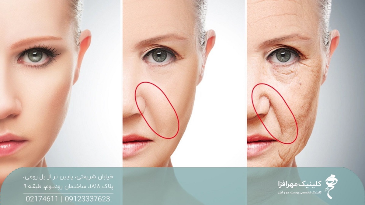 سه عکس از مراحل مختلف رفع خط لبخند زن با تزریق فیلر