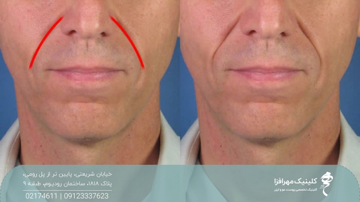 عکس قبل و بعد تزریق ژل خط خنده برای مرد که باعث شده خط عمیق کنار بینی و دهان او محو شود