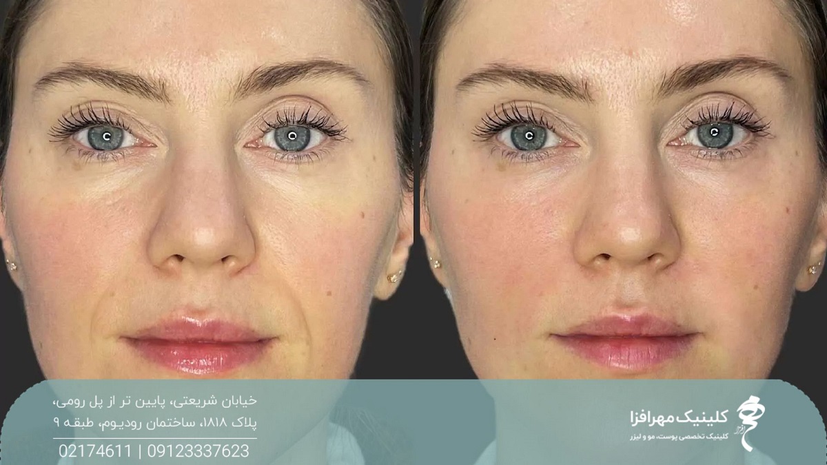 عکس قبل و بعد از رفع خط لبخند دختر با تزریق ژل
