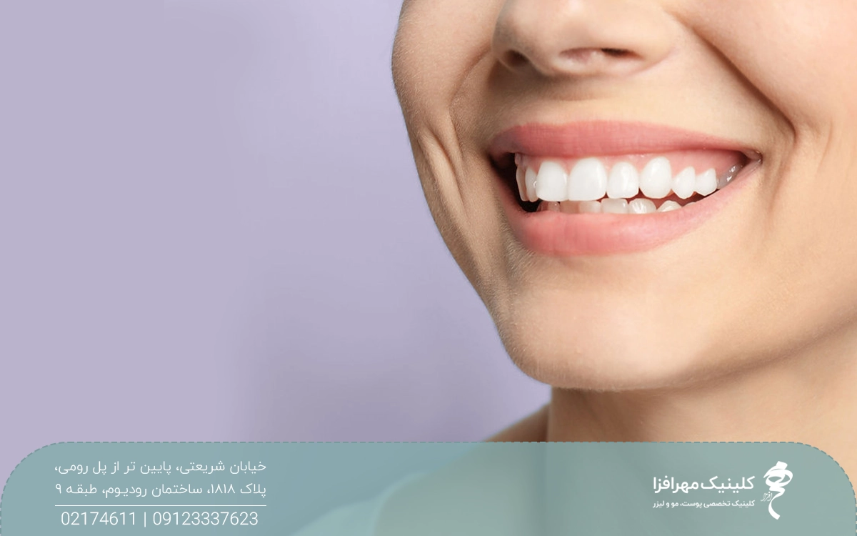 دختری که لبخند زده است و در خط خنده او چروک افتاده است