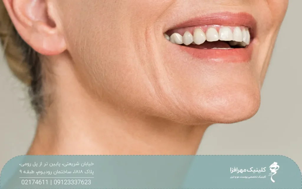 دختری که لبخند زده و اطراف دهان او خطوط و چین و چروک مشخص شده است