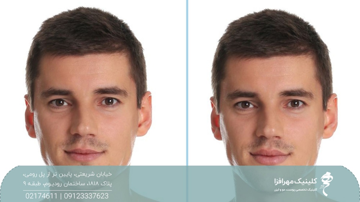 عکس قبل و بعد از کل صورت مرد جوانی که تزریق ژل لب انجام داده است