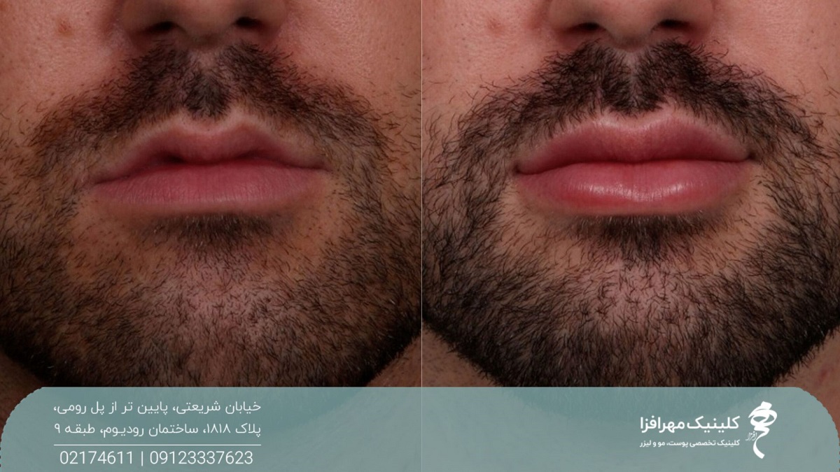 عکس قبل و بعد تزریق ژل لب مردانه که باعث حجیم شدن لبهای مرد شده است