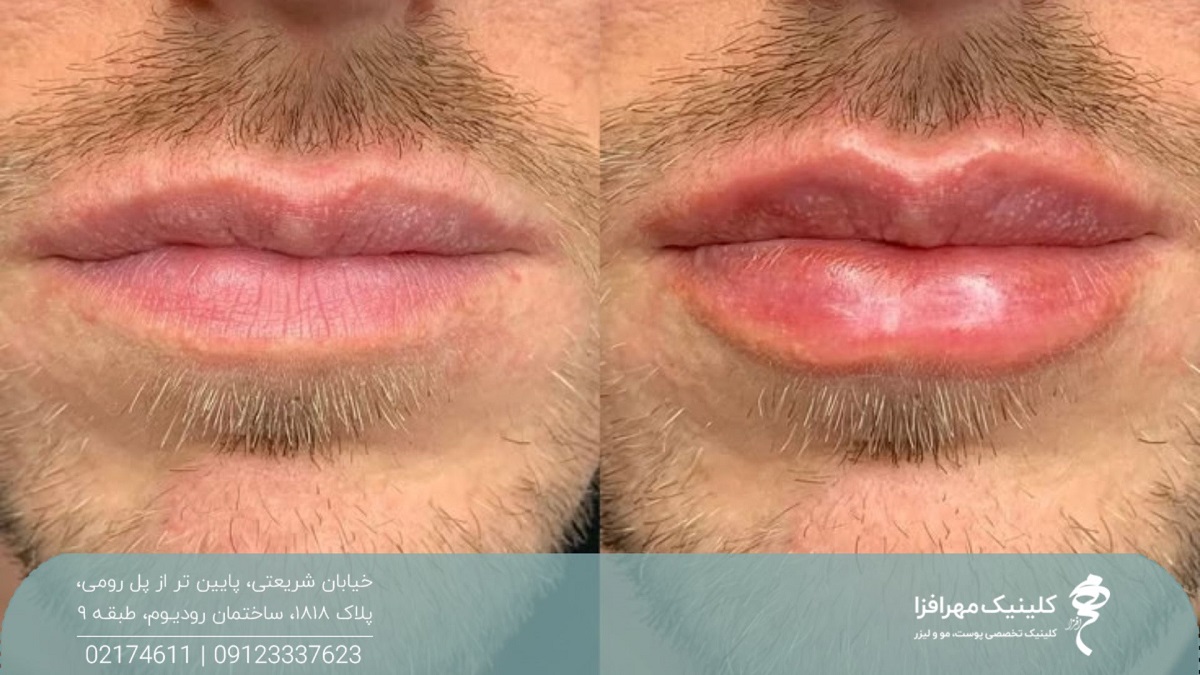 عکس از قبل و بعد تزریق فیلر به لب مرد که باعث شده لب های او بزرگ تر شود