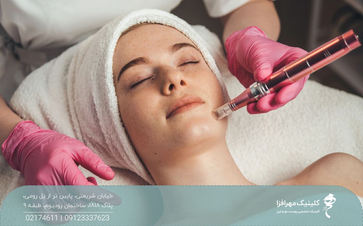 دختری که روی میز اسپا خوابیده و چشم های خود را بسته و پزشک پوست صورت او را مزونیدلینگ می کند