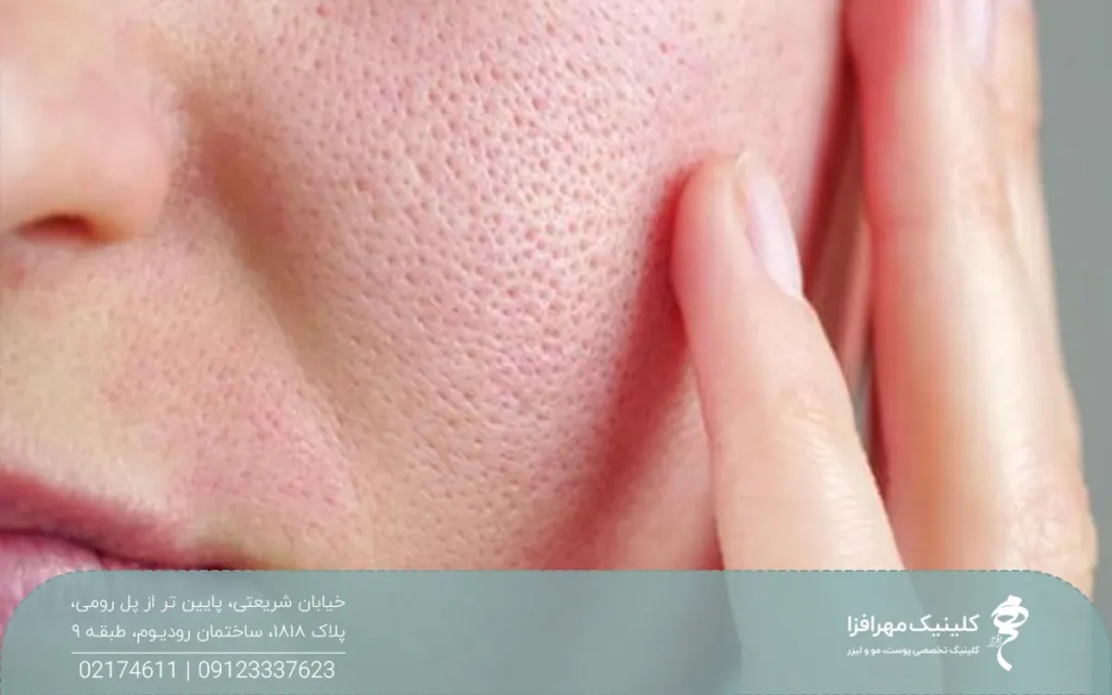 فردی که پوست صورتش منافذ باز دارد و دستش روی صورتش است