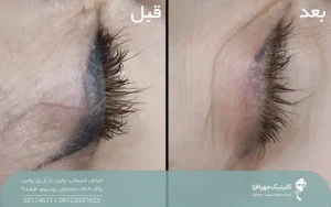 قبل و بعد فردی که تاتو خط چشم خود را پاک کرده است