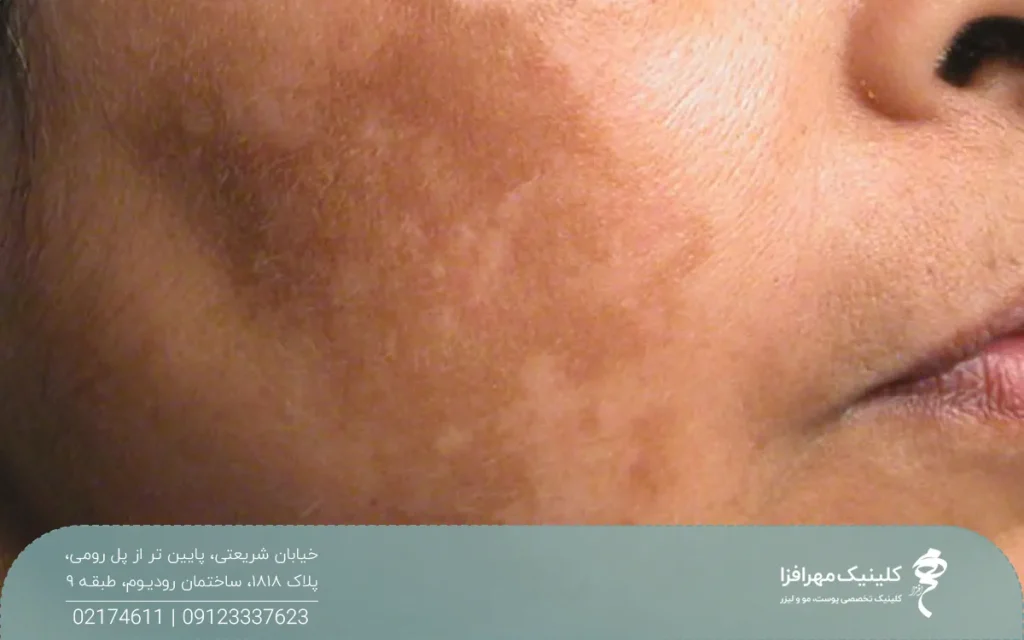 قسمتی از صورت فردی که دچار تیرگی و لک پوستی شده است