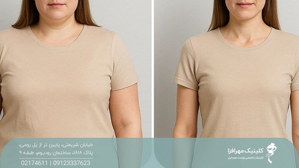 عکس قبل و بعد از لاغر شدن یک زن
