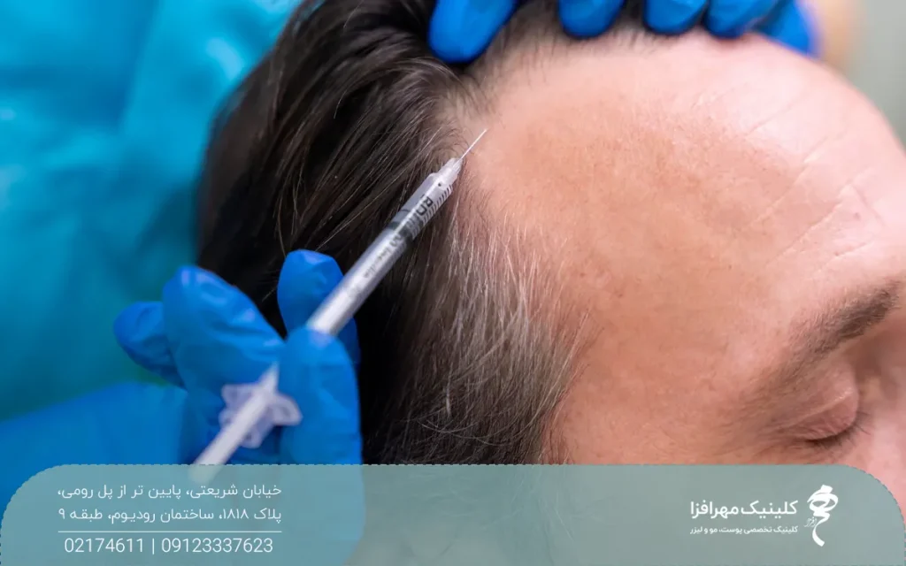 عکس نزدیک از پیشانی مردی که موهای او کم پشت است و پزشکی روی شقیقه های او مزوتراپی مو انجام می دهد