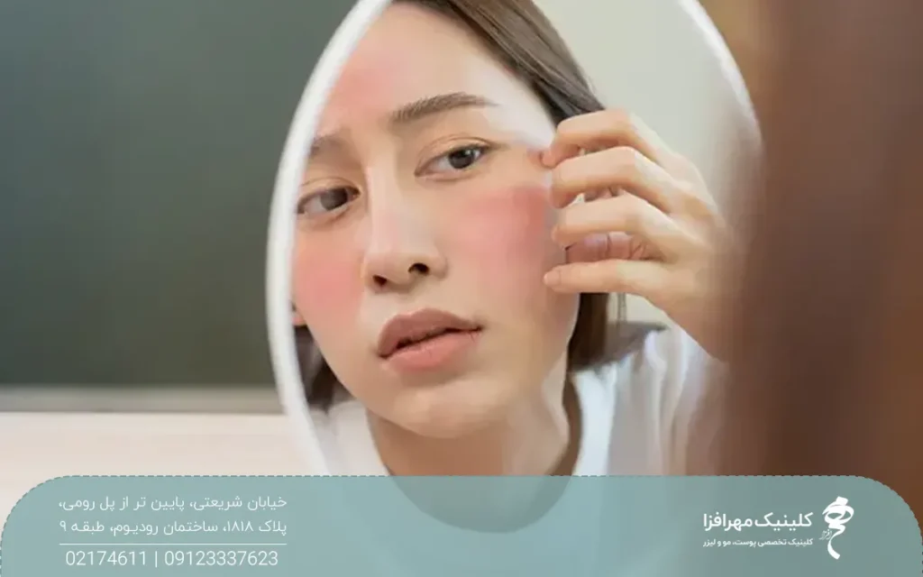 خانم ناراحتی که جلوی آینه است و می بیند که صورتش باد کرده است و دچار ورم شده است